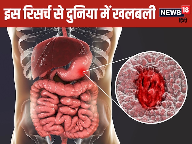 Born between 2008 and 2017, 1.56 crore people threatened this deadly cancer: study