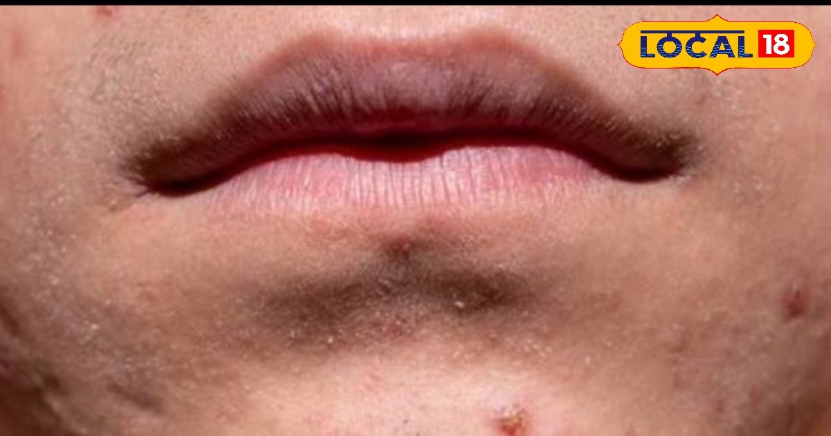 पिंपल्स का जड़ से सफाया करेंगी ये 7 चीजें, आपको घर पर आसानी से मिल जाएंगी