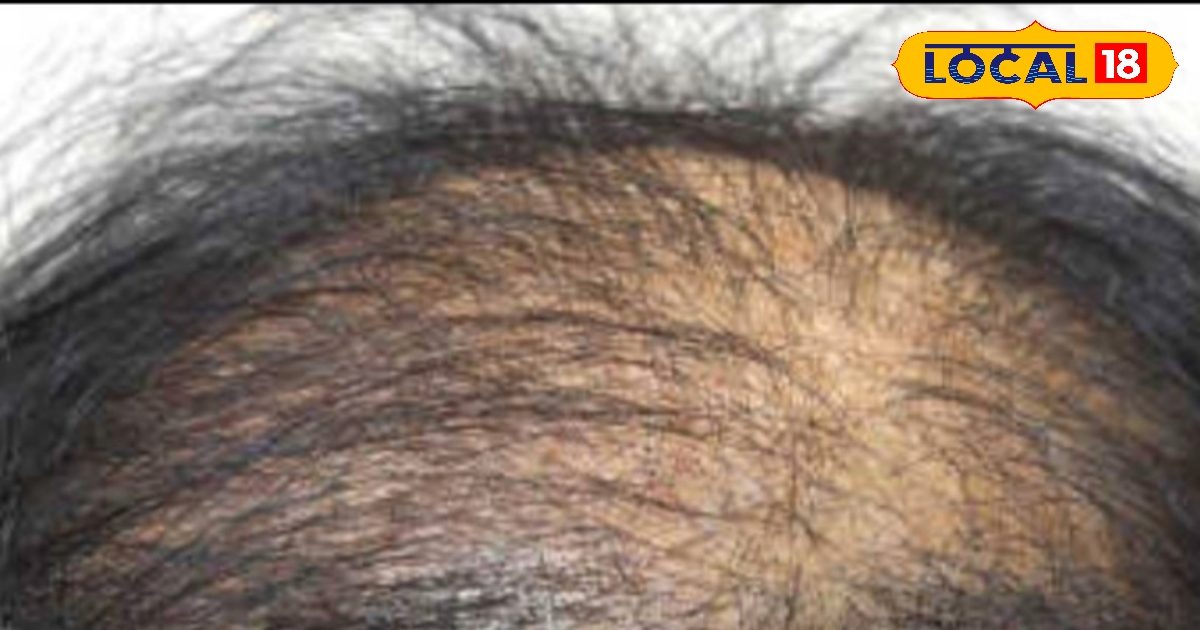 अगर आप भी है बालों की समस्या से परेशान, तो अपनाएं ये 5 घरेलू उपाय, सिर्फ 30 मिनट में दिखेगा असर!