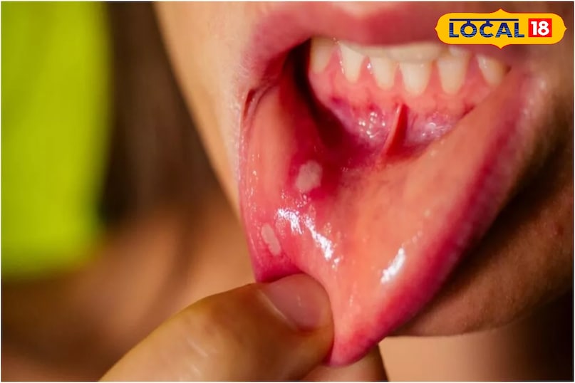 Mouth blisters Mouth blisters