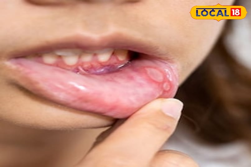 Mouth blisters Mouth blisters