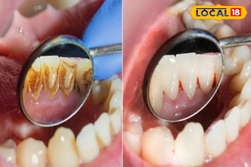 Dental tips Dental tips