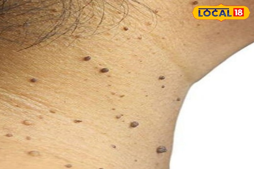 Removal of warts Removal of warts