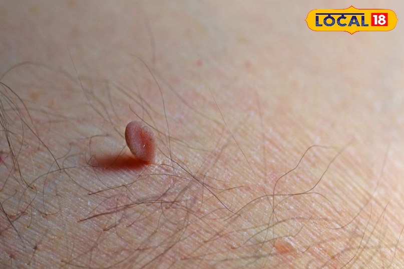 Continuity in the treatment of warts Continuity in the treatment of warts
