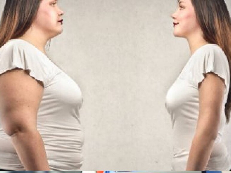 Lifestyle also has to be changed after bariatric surgery that reduces obesity, so that the weight does not increase again. 