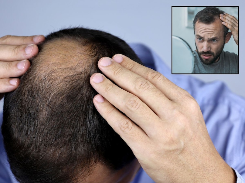 hair loss, sudden hair loss