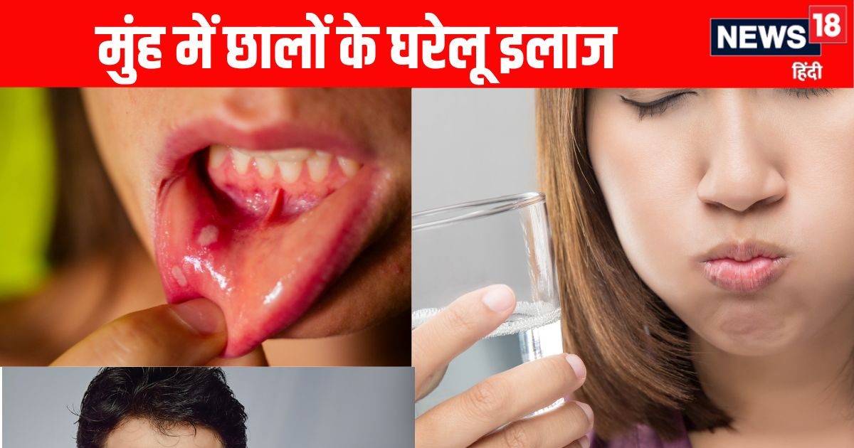 Muh ke chhalon ke Ilaj: मुंह के छालों का 6 देसी घरेलू इलाज, नमक, शहद, एलोवेरा जेल से मिनटों में दर्द, जलन होगा कम