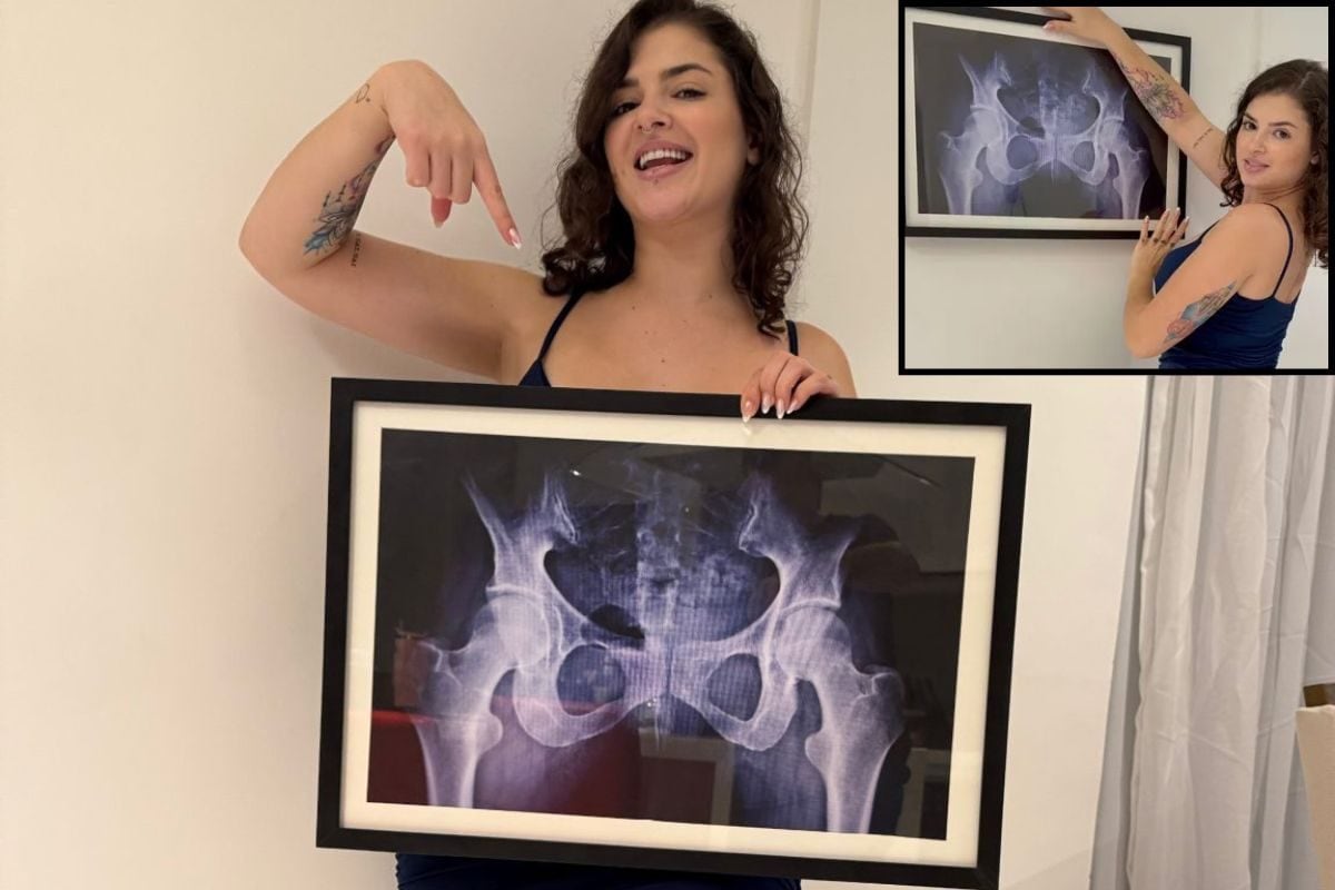 फिगर को लोग समझते थे सर्जरी का नतीजा, तानों से तंग आई लड़की, X-ray कराया!