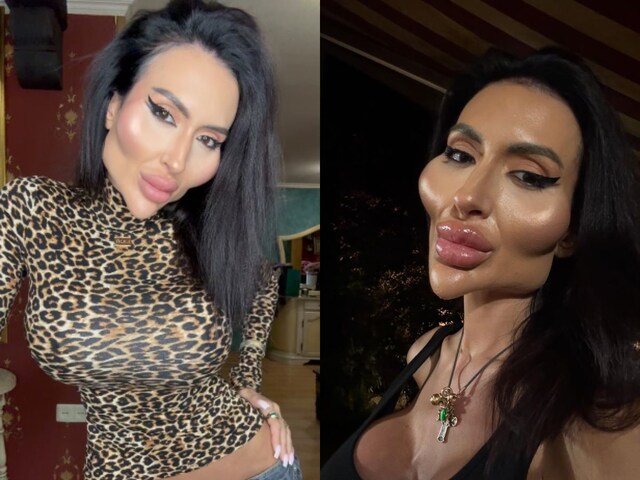 The world's largest cheeks model was seen before plastic surgery