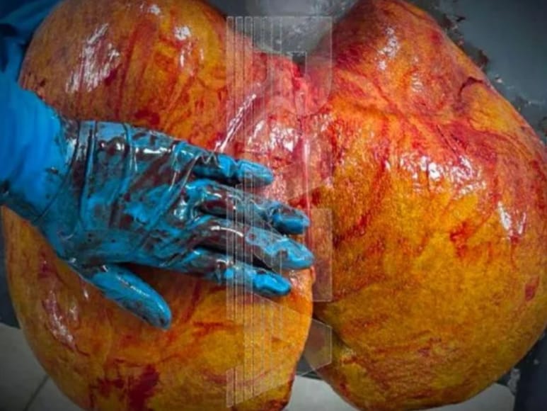 Viral video, viral videos, offbeat, trending, weird news, amazing news, liver, giant liver, mutant liver, liver disease, amazing disease, woman liver, huge liver, health, Russia, Russia, Russia, Russia,