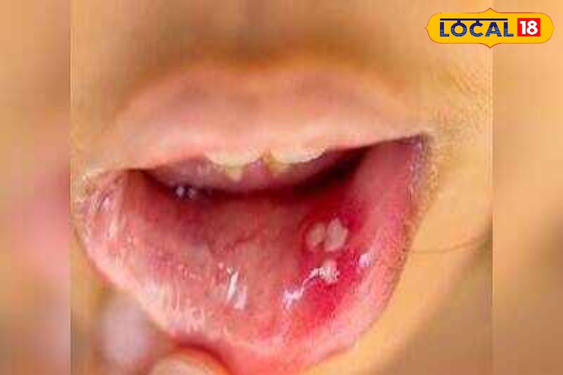 Tips and Tricks: The problem of mouth ulcers is not getting away even after taking medicine? So these home remedies adopted, will never be again Tips and Tricks: The problem of mouth ulcers is not getting away even after taking medicine? So these home remedies adopted, will never be again