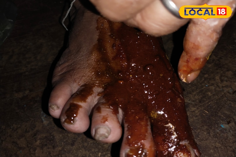 मोच ठीक करने का उपाय मोच ठीक करने का उपाय