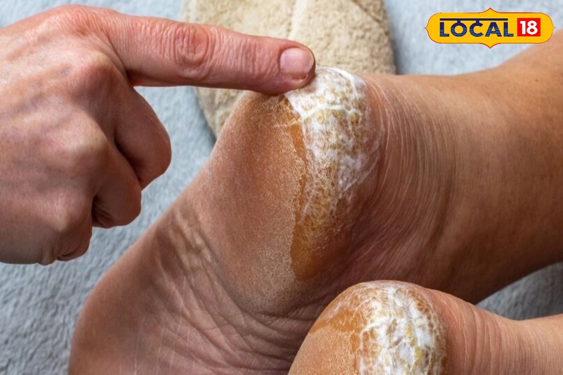 Home remedies vs expensive creams 