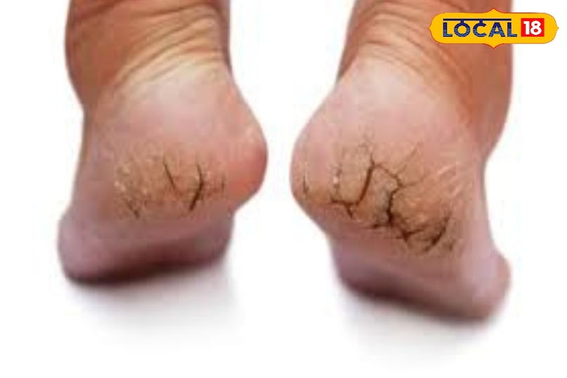 अगर आपकी भी एड़ियां फट रही है, तो लापरवाही बिल्कुल न बरते. आप इसके लिए क्रीम या मरहम तो लगाते हैं ही लेकिन हम आपको ऐसे घरेलू नुस्खे बता रहे है, जिससे आप फटी एड़ियों को आसानी से ठीक कर सकते हैं. ऐसे में हम आपको ऐसे उपाय बता रहे है, जिससे आपकी एड़ियां सिर्फ फटने से बचेगी बल्कि और भी अच्छी दिखने लगेगी.