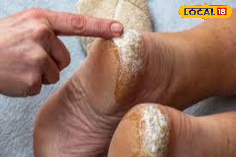 फटी एड़ियां दिखने लगे तो आप नारियल का तेल और कपूर भी लगा सकते हैं. दरअसल, नारियल में एंटी-बैक्टीरियल गुण होते हैं, जो संक्रमण से बचाने में कारगर होते हैं. इसके लिए तीन कपूर की टिकिया को पीसना है और उसमें आधा कप नारियल तेल मिलाकर गर्म करना है. जब ये ठंडा हो जाए, तो फटी एड़ियों पर लगाए. धीरे-धीरे आपको इसका असर दिखने लगेगा.