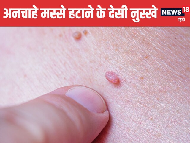 अनचाहे मस्से मिनटों में टूटकर गिर जाएंगे ! अपनाएं 5 बेहद असरदार घरेलू नुस्खे