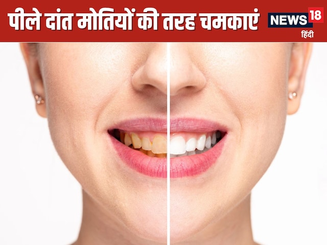 Yellow teeth will also shine like beads overnight! Try 5 effective home remedies Yellow teeth will also shine like beads overnight! Try 5 effective home remedies