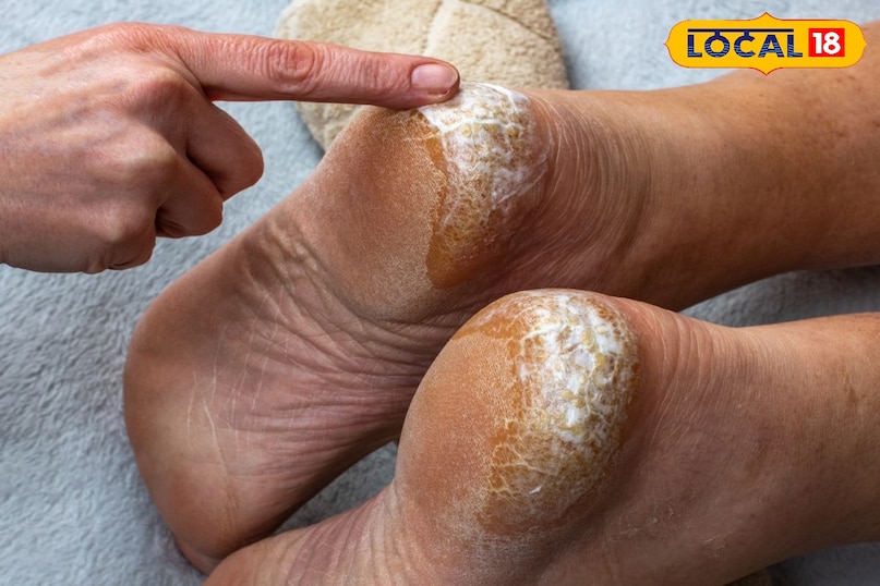 विटामिन E कैप्सूल और नींबू का तेल विटामिन E त्वचा को रिपेयर करने और उसे गहराई से पोषण देने का काम करता है। विटामिन E कैप्सूल को काटकर उसका तेल निकाल लें इसमें नींबू का रस मिलाएं इस मिश्रण को रात में सोने से पहले एड़ियों पर लगाएं और कॉटन के मोज़े पहनकर सो जाएं। सुबह उठकर पैर धो लें। विटामिन E त्वचा की सूजन और दरारें भरता है, जबकि नींबू मृत त्वचा को हटाता है विटामिन E कैप्सूल और नींबू का तेल विटामिन E त्वचा को रिपेयर करने और उसे गहराई से पोषण देने का काम करता है। विटामिन E कैप्सूल को काटकर उसका तेल निकाल लें इसमें नींबू का रस मिलाएं इस मिश्रण को रात में सोने से पहले एड़ियों पर लगाएं और कॉटन के मोज़े पहनकर सो जाएं। सुबह उठकर पैर धो लें। विटामिन E त्वचा की सूजन और दरारें भरता है, जबकि नींबू मृत त्वचा को हटाता है