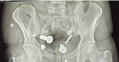 महिला के पेट में छूटा बैंडेज (सांकेतिक तस्वीर)