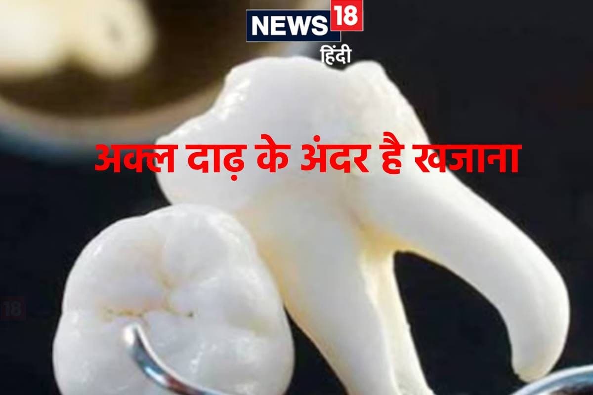 अक्ल दाढ़ में भरा होता है ऐसा खजाना! अब जिससे गंभीर बीमारियों का होगा इलाज