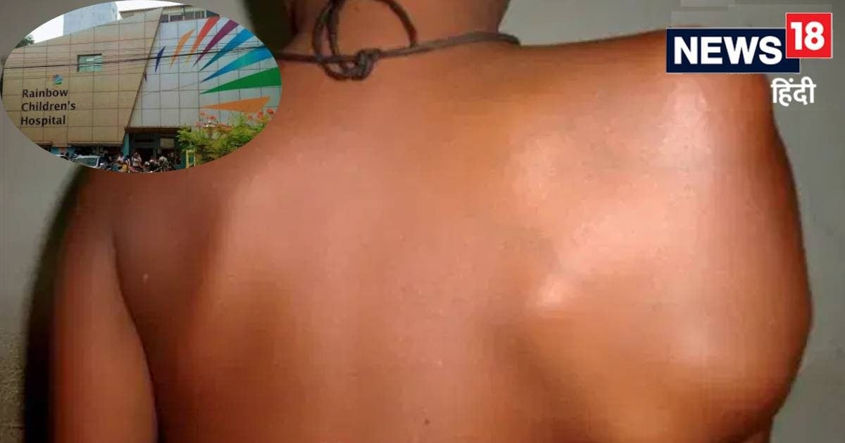 पूरे इलाज के बाद और खतरनाक होकर लौटा हड्डियों का कैंसर, 8 साल के बच्चे....