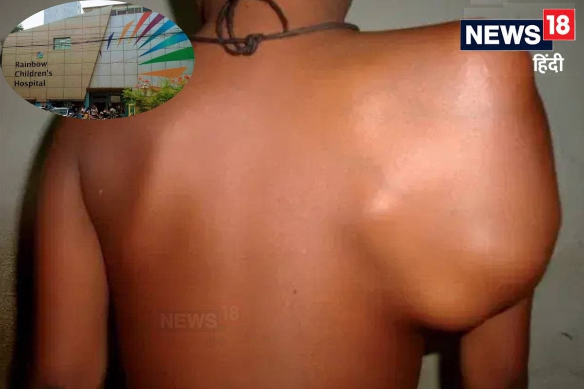 पूरे इलाज के बाद और खतरनाक होकर लौटा हड्डियों का कैंसर 8 साल के बच्चे