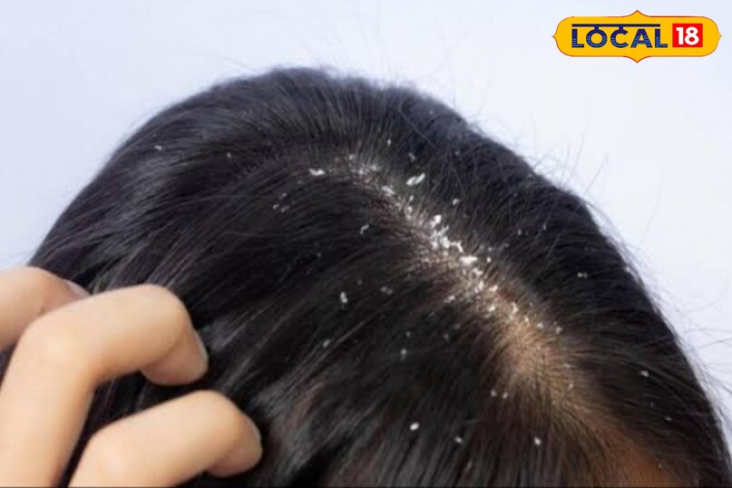 remedy for hair dandruff remedy for hair dandruff