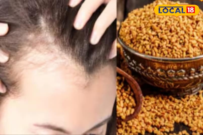 remedy for hair dandruff remedy for hair dandruff