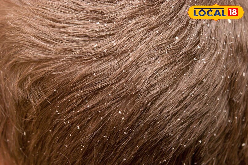 डैंड्रफ