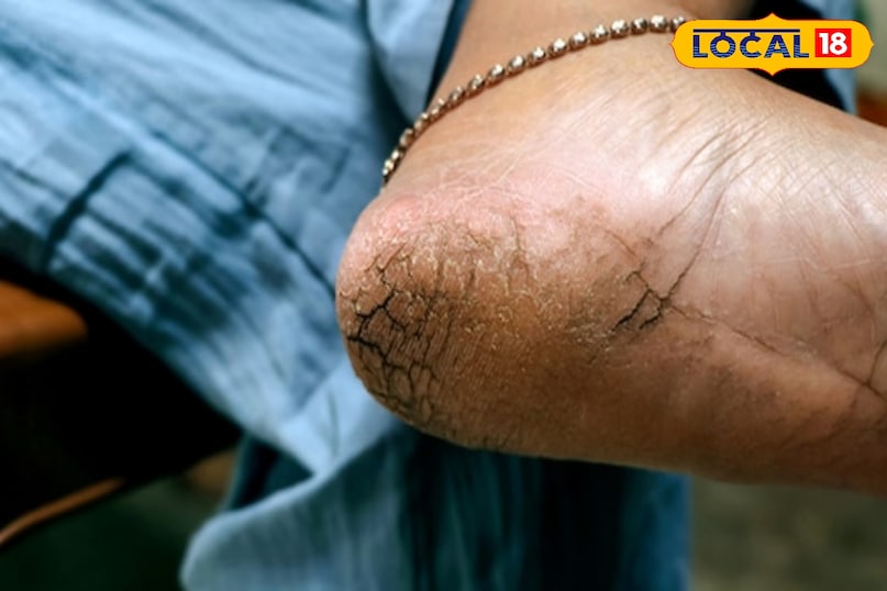 cracked heels causes 