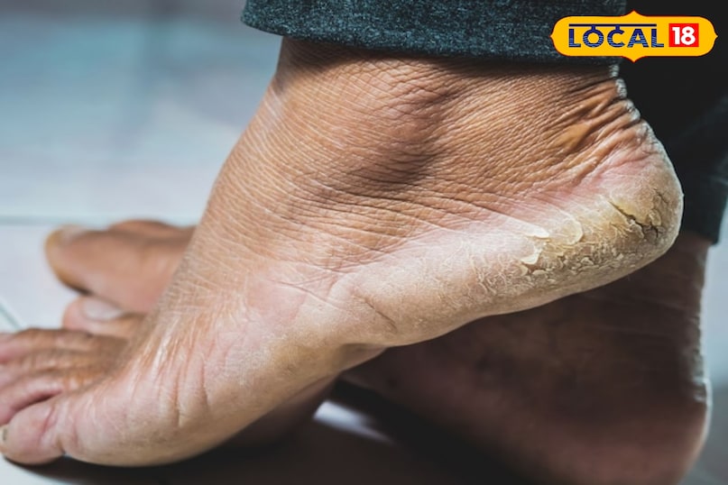 cracked heels causes 