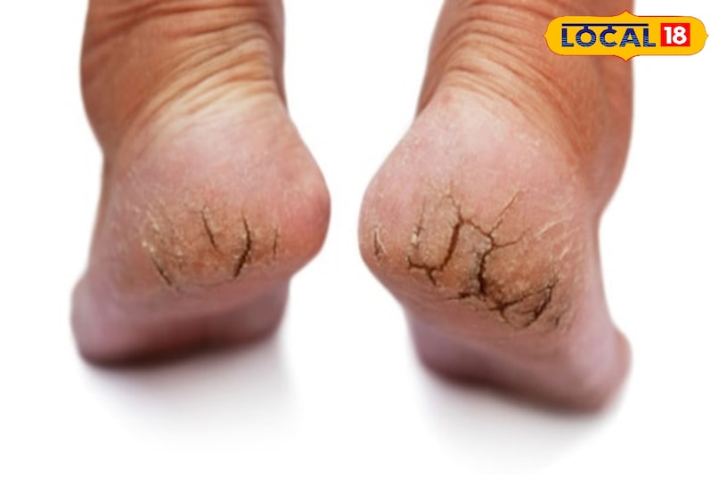 cracked heels causes 