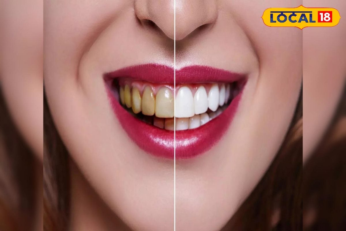 https://images.news18.com/ibnkhabar/uploads/2025/11/HYP_5572594_howtodoteethwhiteningathomemustardoilandsalthelpke_7-3x2.jpg