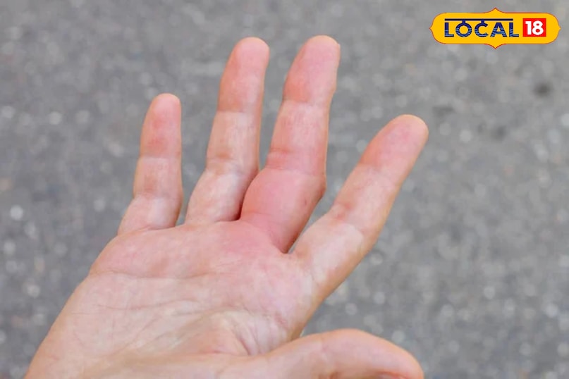 हाथ पैर में है स्वेलिंग तो अपनाए यह नुस्खे 