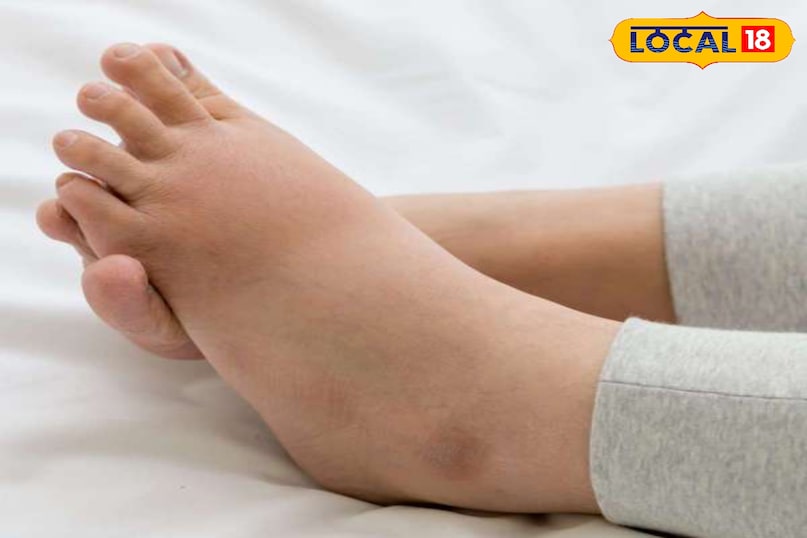 हाथ पैर में है स्वेलिंग तो अपनाए यह नुस्खे