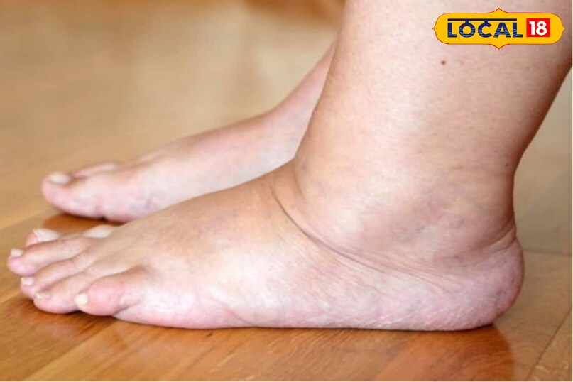 शरीर की सूजन घटना भिंडी और नींबू दोनों में ही सूजन कम करने के गुण होते हैं। अगर शरीर में कहीं छुपी हुई सूजन हैतो रोज़ाना इस पानी को पीने से वह धीरे-धीरे कम हो सकती है। 