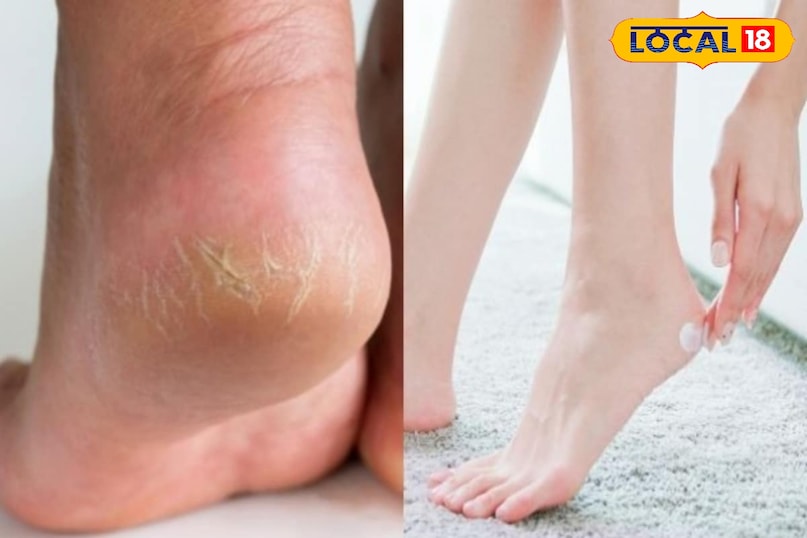 सर्दियों में फटी एड़ियों का घरेलू इलाज सर्दियों में फटी एड़ियों का घरेलू इलाज