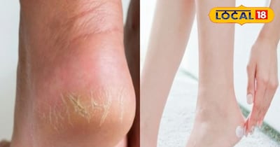 सर्दियों में फटी एड़ियों से पाएं छुटकारा: आजमाएं मोम का यह असरदार घरेलू नुस्खा