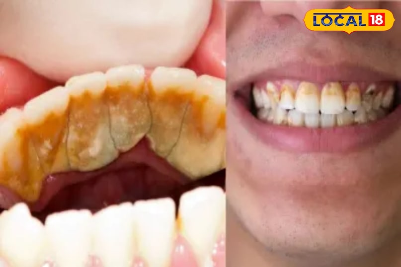 पीले दांत पीले दांत