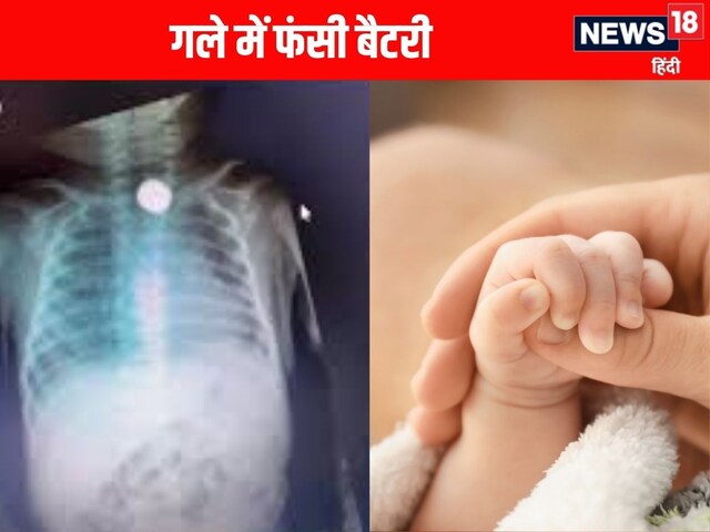 Battery stuck in food pipe of 5 month old baby, doctor saved his life like this Battery stuck in food pipe of 5 month old baby, doctor saved his life like this