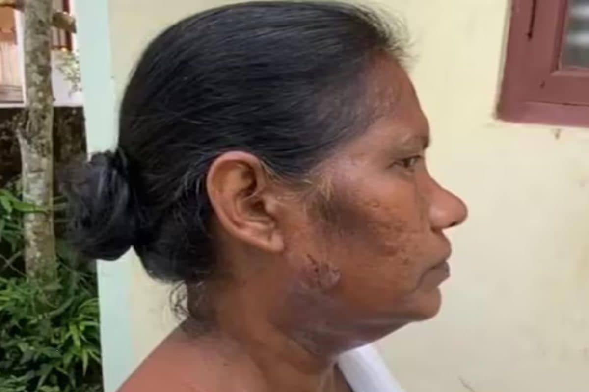 केरल में वोटर लिस्ट अपडेट करने गई BLO ऑफिसर पर छोड़ा कुत्ता चेहरे पर काटा