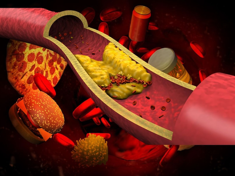 आपने अक्सर सुना होगा कि फलां व्यक्ति डांस करते-करते हार्ट अटैक का शिकार हो गया. ऐसी बातें चलने लगती है कि उसे कुछ नहीं हो रहा था लेकिन हार्ट अटैक हो गया. दरअसल, अगर किसी को हार्ट अटैक आता है तो इसका लक्षण पहले से नहीं दिखता. यह अंदर ही अंदर शरीर में घटने वाली प्रक्रिया है. हार्ट अटैक के अधिकांश मामलों में हाई कोलेस्ट्रॉल कारण होता है. जब खून में कोलेस्ट्रॉल की मात्रा बढ़ जाती है तब यह धमनियों की दीवार से चिपकने लगता है और इस तरह यह हार्ट तक खून पहुंचने में बाधा पहुंचाता है. जब हार्ट तक खून नहीं पहुंचेगा तो हार्ट अटैक हो जाएगा. आपने अक्सर सुना होगा कि फलां व्यक्ति डांस करते-करते हार्ट अटैक का शिकार हो गया. ऐसी बातें चलने लगती है कि उसे कुछ नहीं हो रहा था लेकिन हार्ट अटैक हो गया. दरअसल, अगर किसी को हार्ट अटैक आता है तो इसका लक्षण पहले से नहीं दिखता. यह अंदर ही अंदर शरीर में घटने वाली प्रक्रिया है. हार्ट अटैक के अधिकांश मामलों में हाई कोलेस्ट्रॉल कारण होता है. जब खून में कोलेस्ट्रॉल की मात्रा बढ़ जाती है तब यह धमनियों की दीवार से चिपकने लगता है और इस तरह यह हार्ट तक खून पहुंचने में बाधा पहुंचाता है. जब हार्ट तक खून नहीं पहुंचेगा तो हार्ट अटैक हो जाएगा.