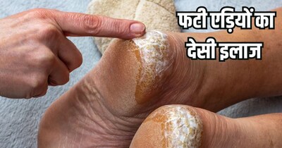फड़ी एड़ियों का घरेलू आसान इलाज.
