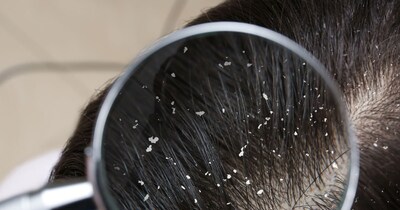 Permanent cure for dandruff