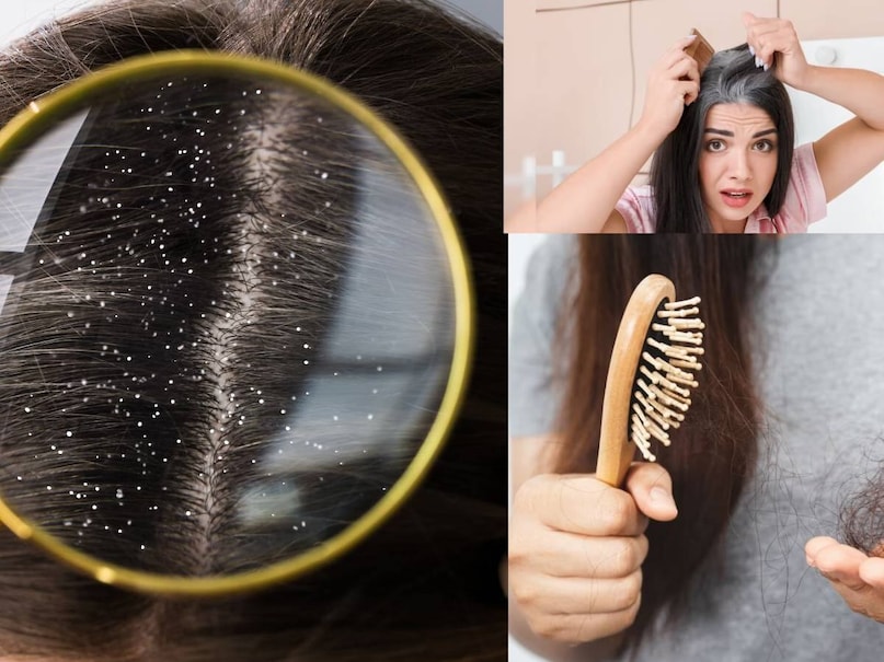 শীতের আগমনের সঙ্গে সঙ্গে খুশকি, চুলকানি এবং চুল পড়া হঠাৎ করে বেড়ে যায়, যার ফলে মানুষ বিভিন্ন শ্যাম্পু এবং চিকিৎসা চেষ্টা করে। কিন্তু আপনি যদি কোনও রাসায়নিক ছাড়াই শীতের এই চুলের সমস্যা থেকে মুক্তি পেতে চান, তাহলে আপনার বাড়ির আশেপাশে জন্মানো একটি সাধারণ গাছ গেম চেঞ্জার প্রমাণিত হতে পারে। এই গাছটি মাথার ত্বককে আর্দ্রতা দেয়, শিকড়কে শক্তিশালী করে এবং খুশকিকে মূল থেকে দূর করার ক্ষমতা রাখে। কেন অ্যালোভেরা শীতের সবচেয়ে কার্যকর প্রতিকার?