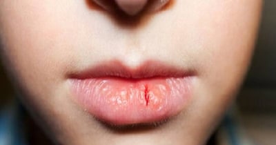 Lips Care Tips In Winter 