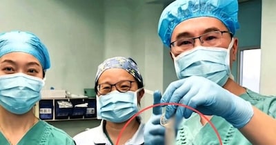 Doctors in Chengdu ingeniously remove lighter from man's stomach after 30 years using a condom