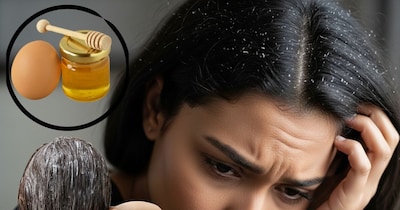 Egg Hair Masks Uncover Natural Dandruff Remedy, Reveal Steps to Remove Odor and Boost Scalp Health