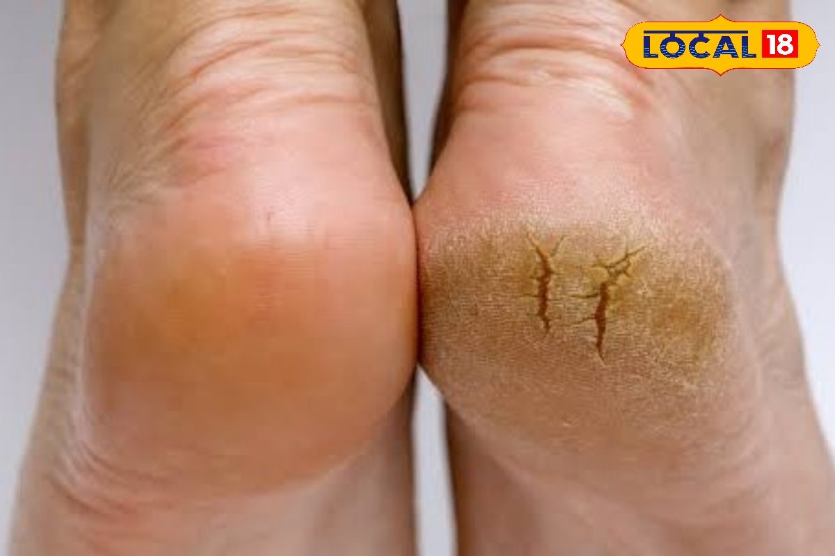 सर्दियां शुरू होते ही फटने लगी एड़ियां? रात को सोने से पहले करें ये घरेलु उपाय