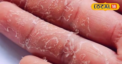 ठंड में हाथों की रूखी त्वचा और अपरस से परेशान, कैसे मिलेगा राहत